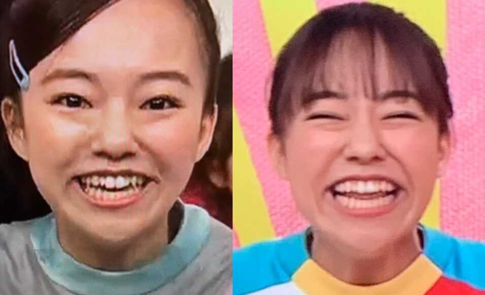 あづきお姉さんが可愛くなった理由3選!歯列矯正して垢抜けた?